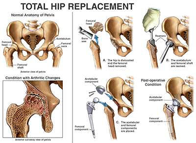 Total Hip Replacement - Procedure, Side Effects, Recovery